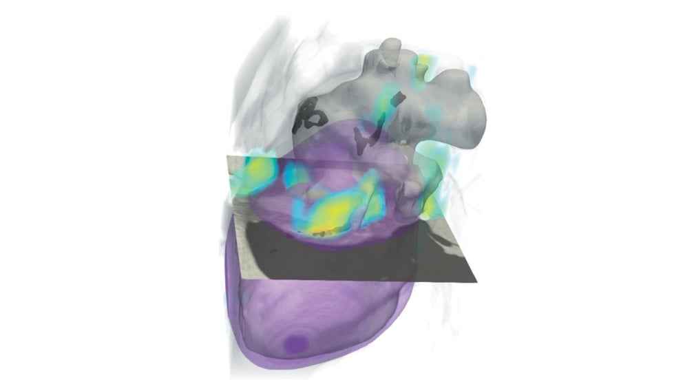 CT scan of the heart 